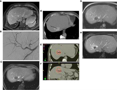 Personalized Image-Guided Therapies for Local Malignencies: Interdisciplinary Options for Interventional Radiology and Interventional Radiotherapy